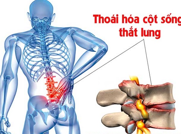 Thoái hóa cột sống cổ -thắt lưng
