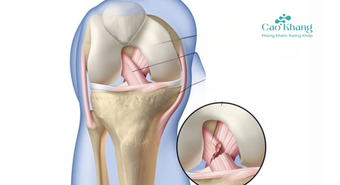 Đứt bán phần / hoàn toàn gân – dây chằng
