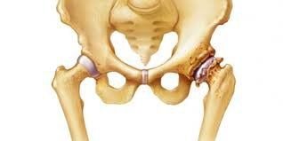 Hoại tử chỏm xương đùi