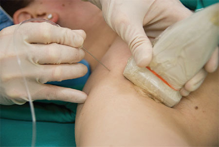 phong-be-than-kinh-ngoai-bien-1