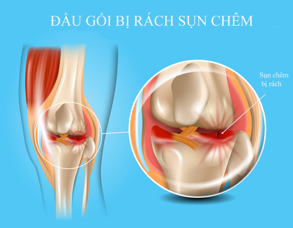Rách sụn chêm